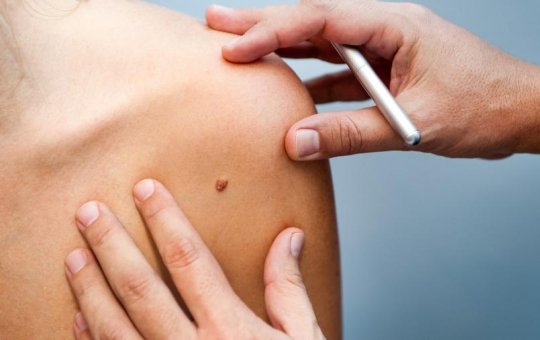 Pacientes com diagnóstico de câncer de pele participarão de estudo mundial para vacina contra a doença