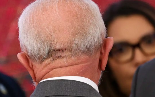 Lula passará por novo procedimento cirúrgico na manhã desta quinta-feira (12)