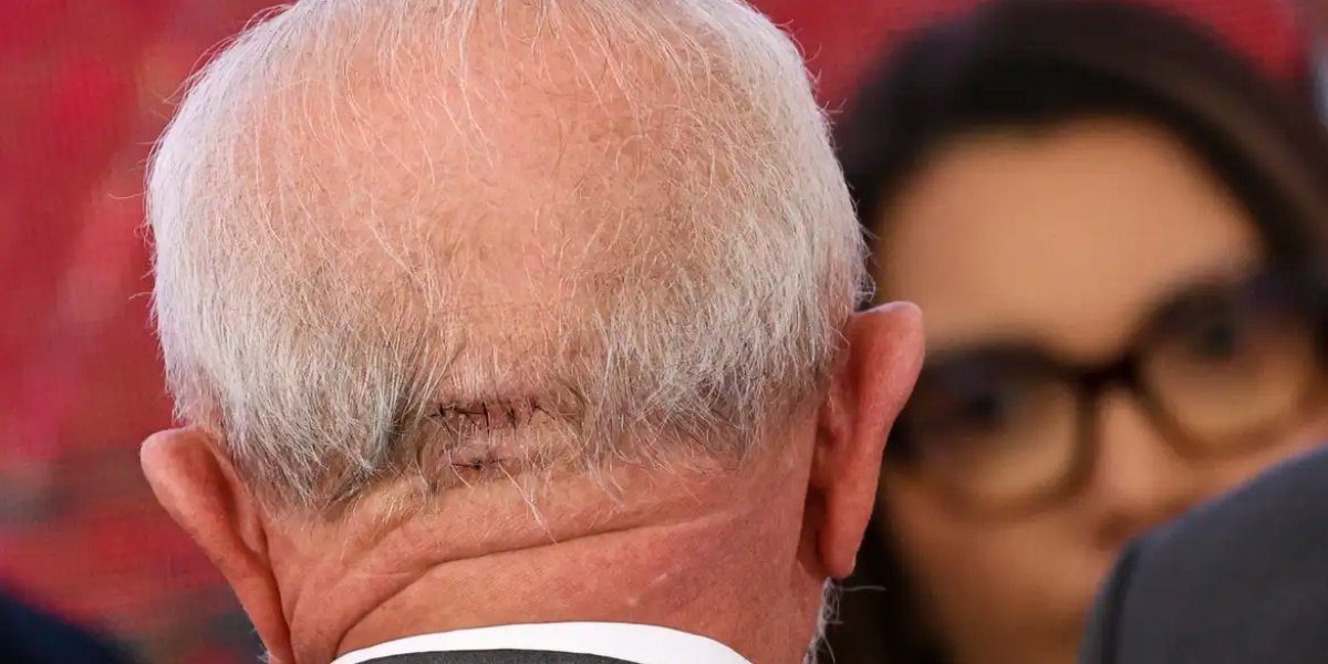 Lula passará por novo procedimento cirúrgico na manhã desta quinta-feira (12)