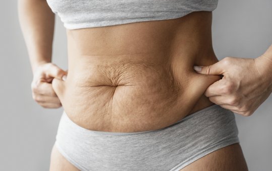 Lipedema: entendendo a doença que afeta o corpo e a qualidade de vida