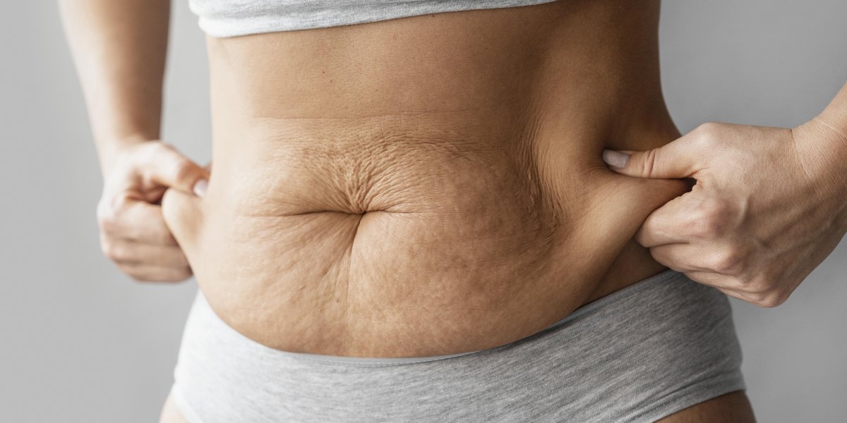 Lipedema: entendendo a doença que afeta o corpo e a qualidade de vida