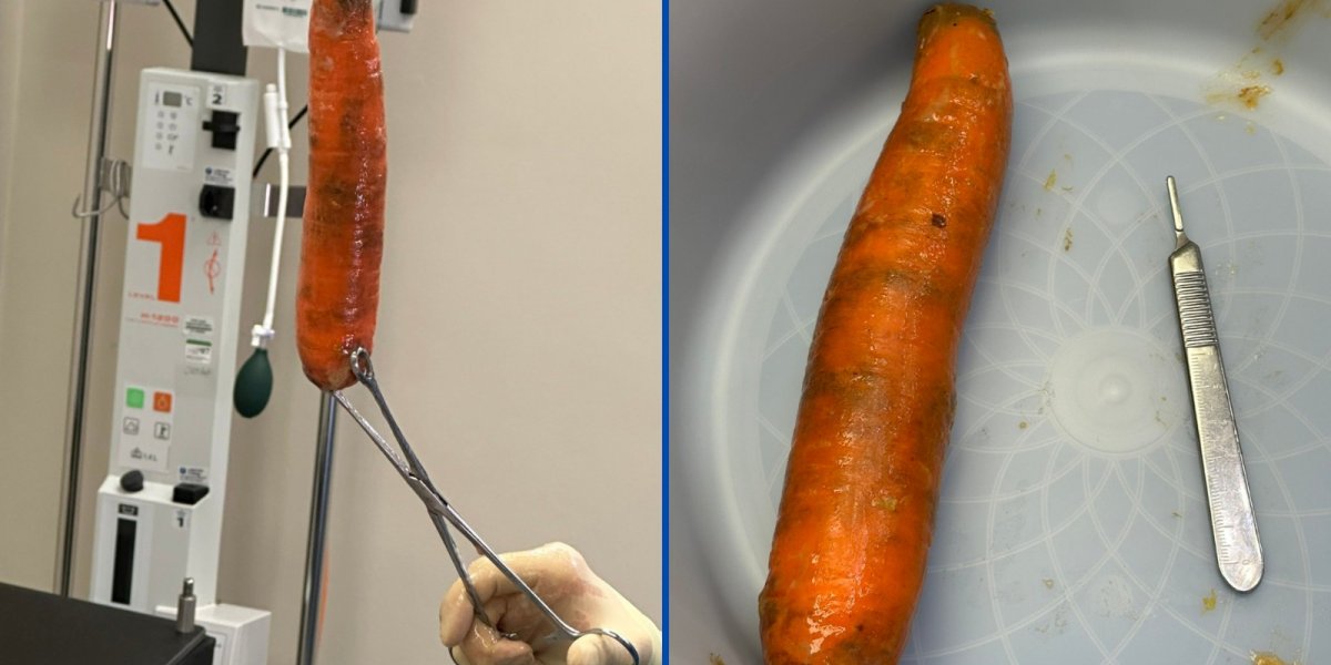Homem é internado após dar entrada em hospital com cenoura de 20cm no ânus