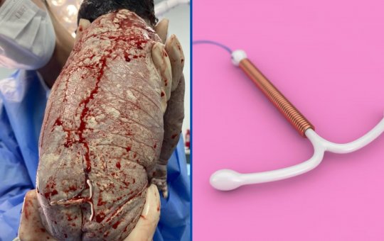 Bebê nasce com DIU colado ao corpo e viraliza nas redes
