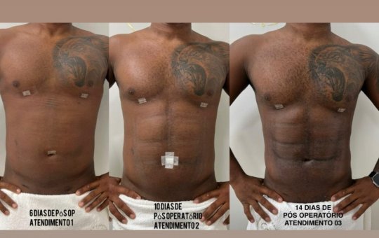 Davi Brito compartilha resultados de sua lipo HD