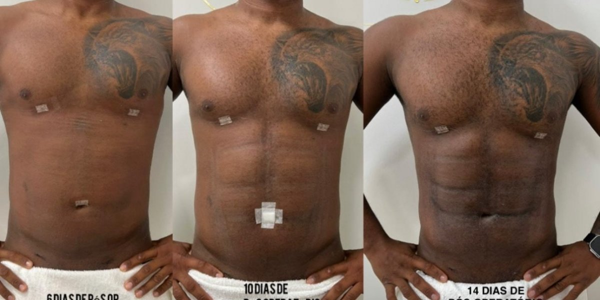 Abdômen de Davi após a cirurgia