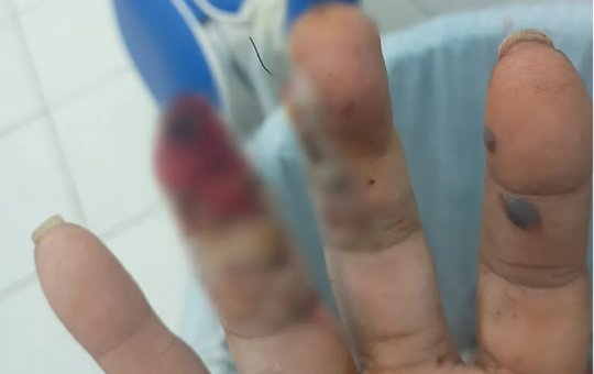 Motorista perde parte do dedo após bomba explodir em carro na Bahia