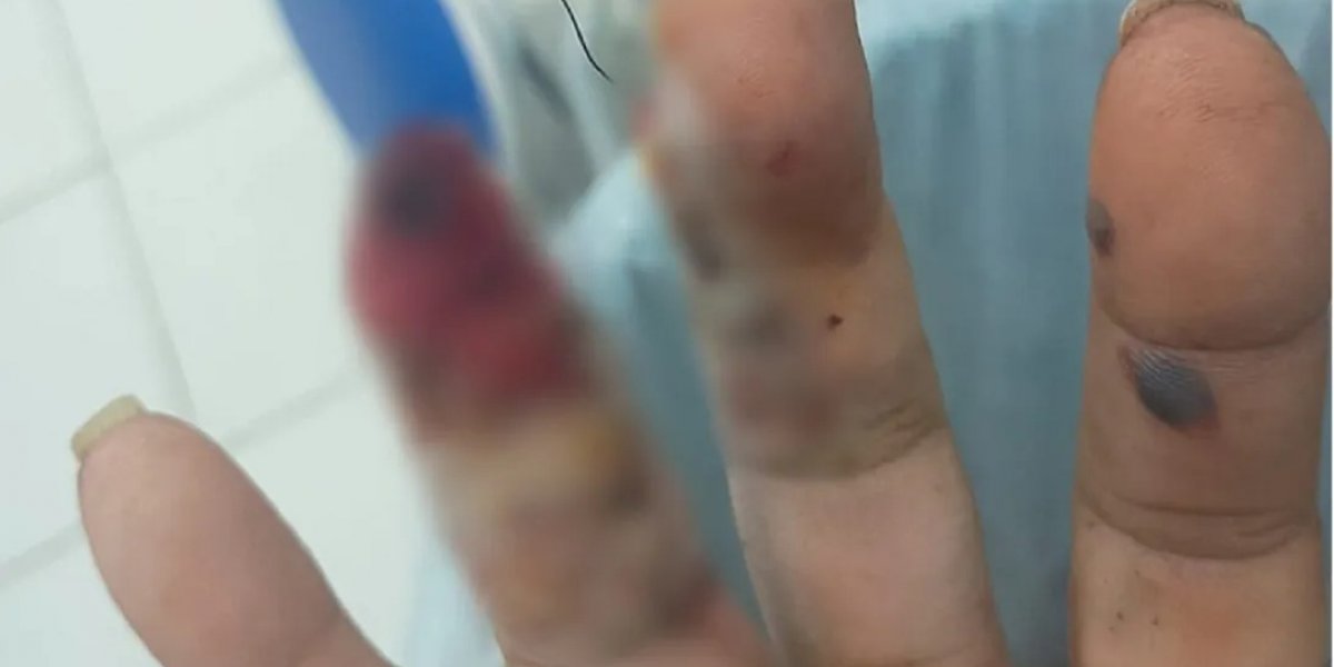 Dedos da vítima feridos