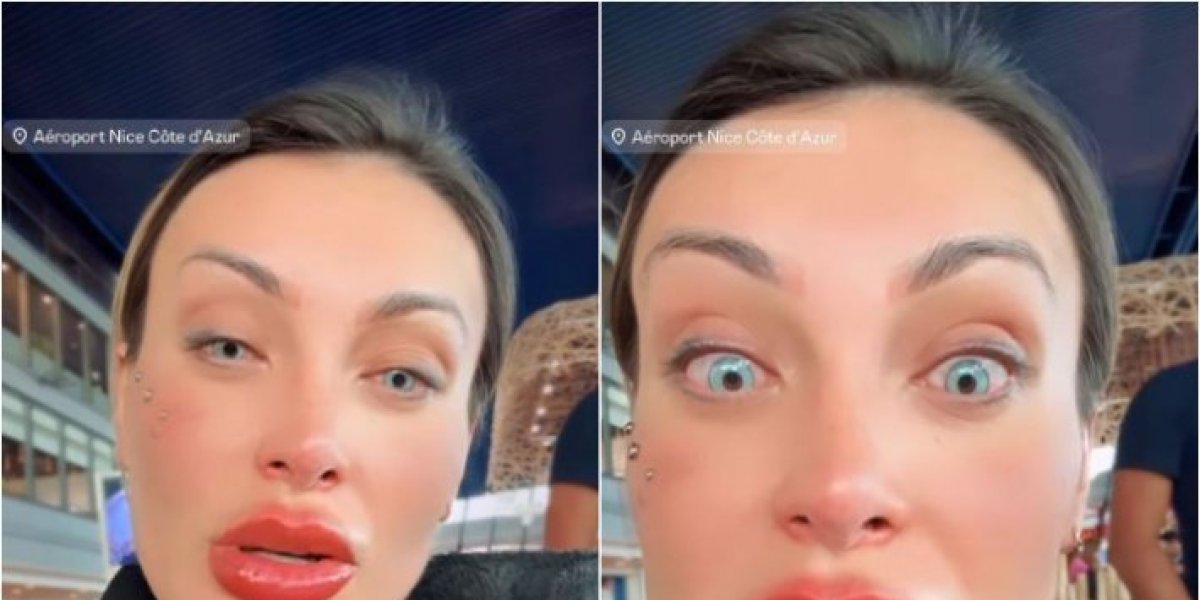 Andressa com os olhos pós-cirurgia