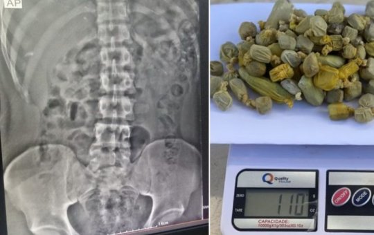 Homem engole mais de 100 gramas de maconha e tenta ser preso para vender a droga em presídio