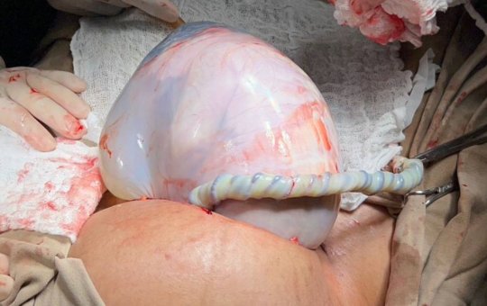 Nascimento raro de gêmeos: bebê nasce envolta pela bolsa amniótica em Irecê