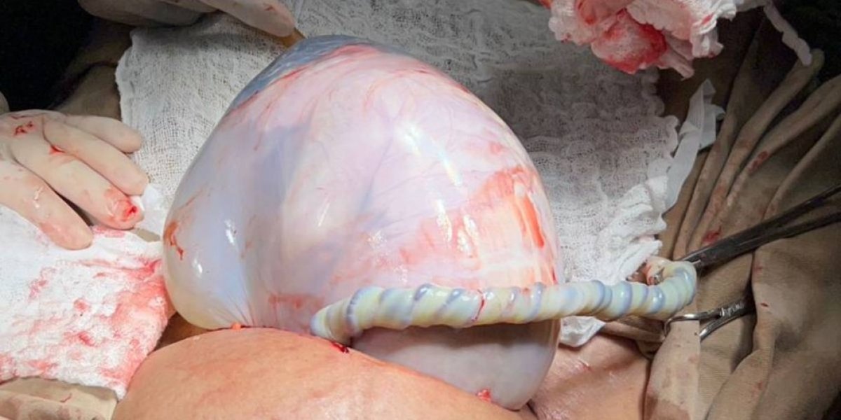 Nascimento raro de gêmeos: bebê nasce envolta pela bolsa amniótica em Irecê