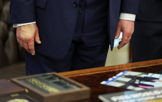 Donald Trump volta a usar maquiagem na mão após diagnóstico de doença