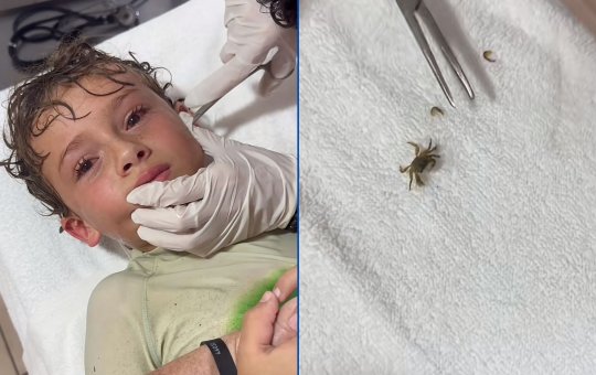 Menino tem caranguejo vivo retirado do ouvido após banho de mar e vídeo viraliza