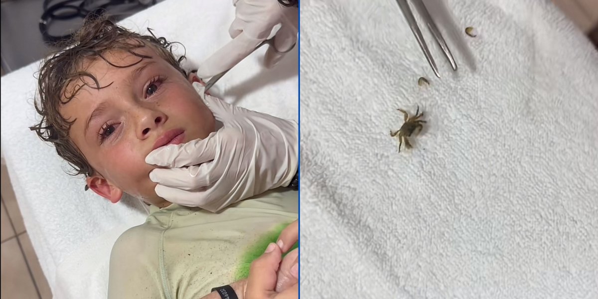 Menino tem caranguejo vivo retirado do ouvido após banho de mar e vídeo viraliza