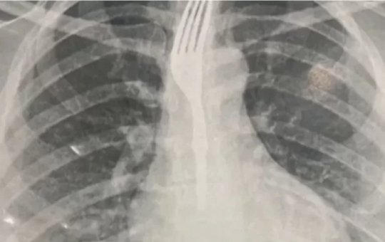 Caso inusitado: mulher engole garfo durante refeição em Guanambi