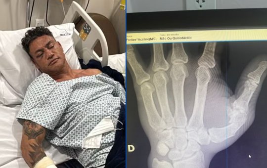 Popó passa por cirurgia após quebrar a mão durante confusão generalizada