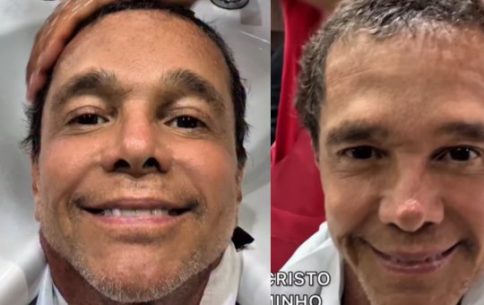 Curado do câncer, Netinho comemora crescimento do cabelo após quimioterapia