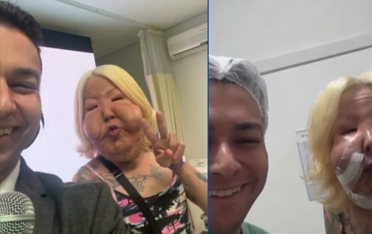 Influenciadora Juju do Pix passa por cirurgia para remover óleo do rosto