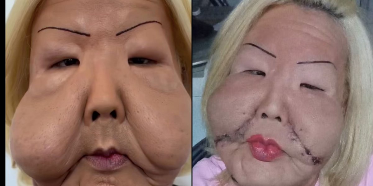 Juju do Pix mostra antes e depois de procedimento cirúrgico para realizar óleo industrial do rosto