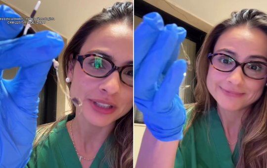 Ginecologista surpreende ao mostrar pelos de gatos enrolados em DIU