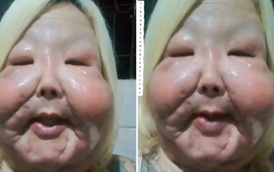 Juju do Pix desabafa e revela problema em cicatrização de cirurgia