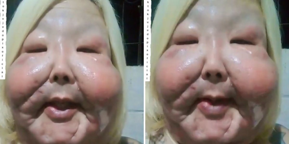 Juju do Pix desabafa e revela problema em cicatrização de cirurgia