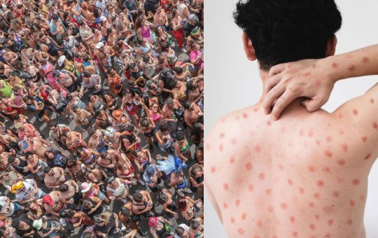 Porto Alegre registra primeiro caso de Mpox em 2026 e Brasil entra em alerta