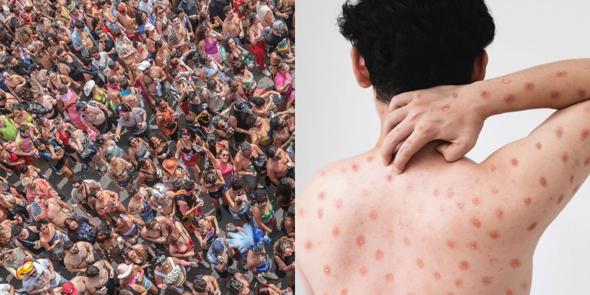 Porto Alegre registra primeiro caso de Mpox em 2026 e Brasil entra em alerta