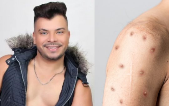 Fotos de cantor paraense que faleceu devido a Mpox viralizam na semana em que o Brasil atinge 90 casos