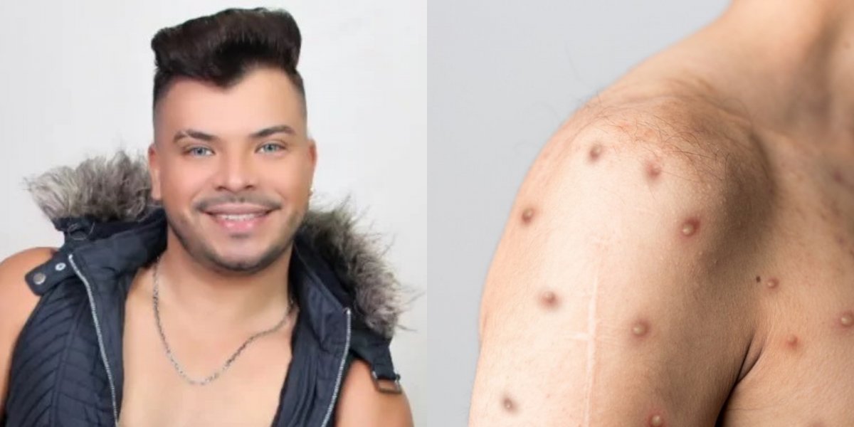 Fotos de cantor paraense que faleceu devido a Mpox viralizam na semana em que o Brasil atinge 90 casos