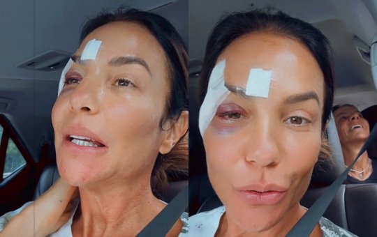Com olho roxo, Ivete Sangalo recebe alta de hospital e explica quadro de saúde