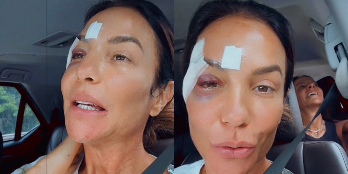Com olho roxo, Ivete Sangalo recebe alta de hospital e explica quadro de saúde