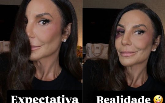 Ivete Sangalo mostra hematoma
