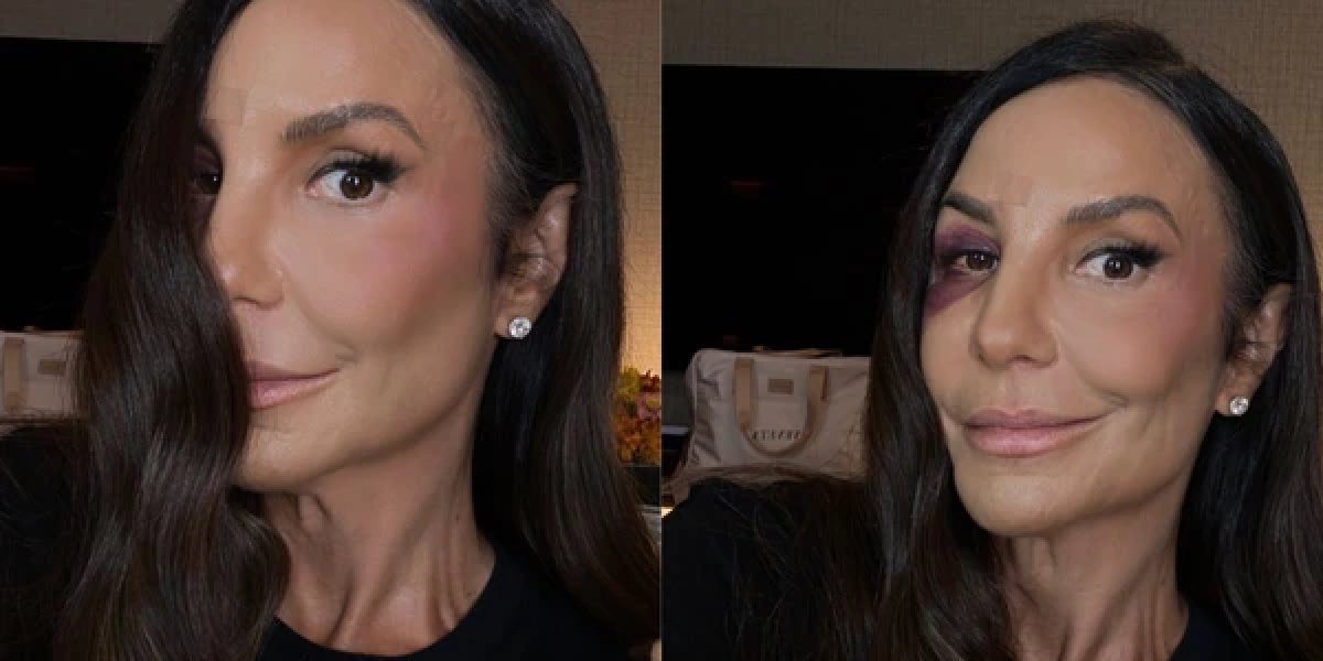 Ivete Sangalo mostra hematoma