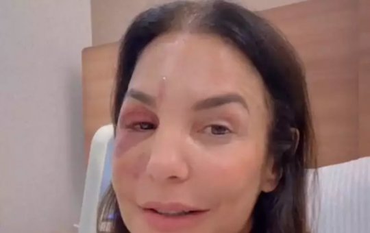 Ivete Sangalo atualiza fãs sobre seu estado de saúde e revela detalhes do acidente