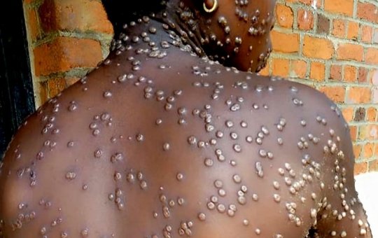 Brasil registra casos preocupantes de mpox; veja sintomas, formas de transmissão e prevenção