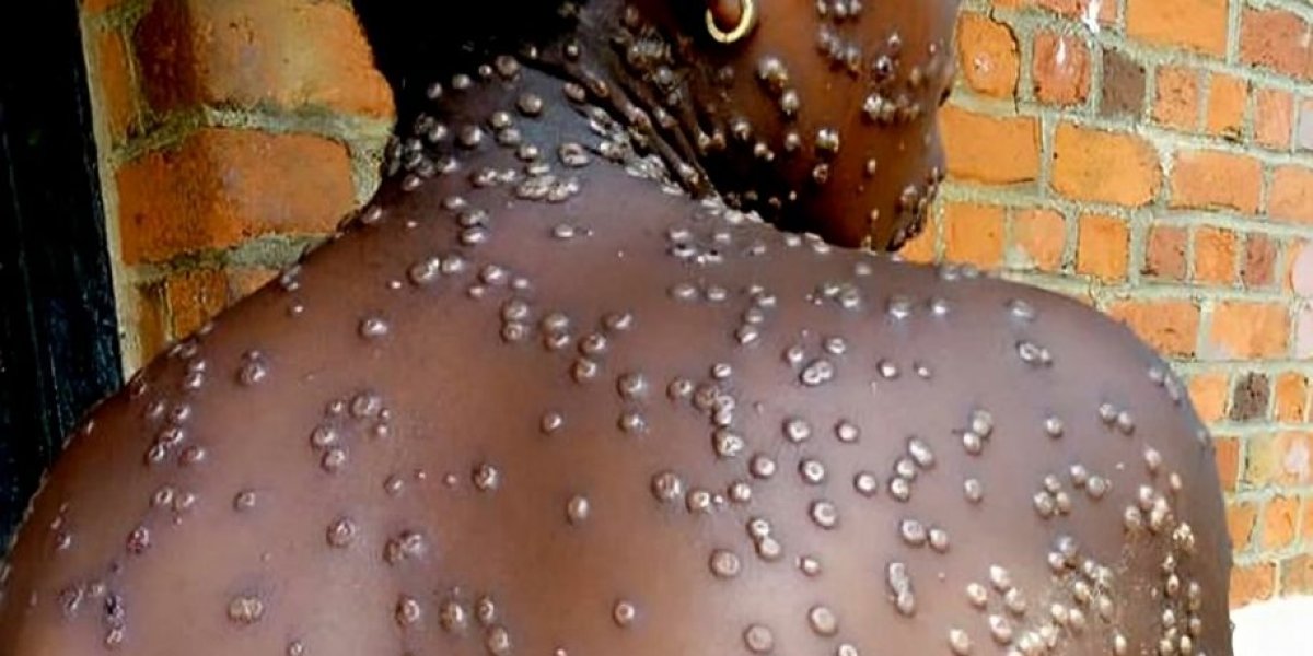 Brasil registra casos preocupantes de mpox; veja sintomas, formas de transmissão e prevenção