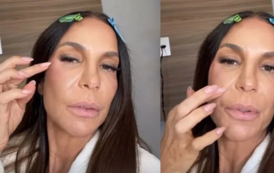 Ivete Sangalo revela que colocou presilhas de titânio no rosto após fratura