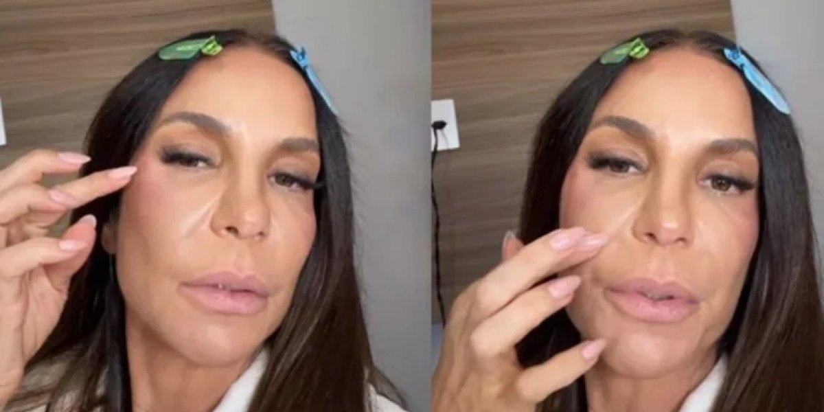 Ivete Sangalo revela que colocou presilhas de titânio no rosto após fratura