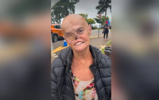Mulher que teve 73 tumores comove ao contar história de superação contra o câncer