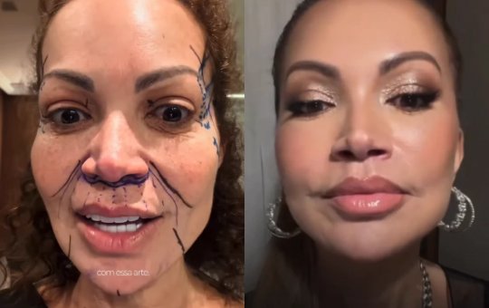 Solange Almeida exibe resultado de lifting facial e surpreende seguidores nas redes