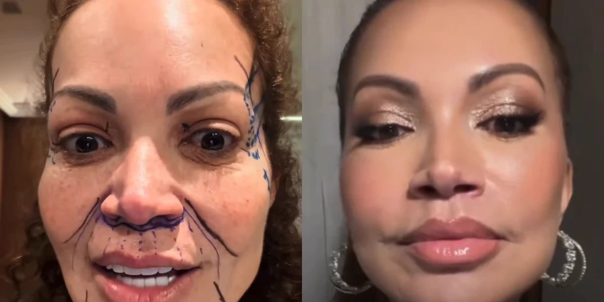 Solange Almeida exibe resultado de lifting facial e surpreende seguidores nas redes
