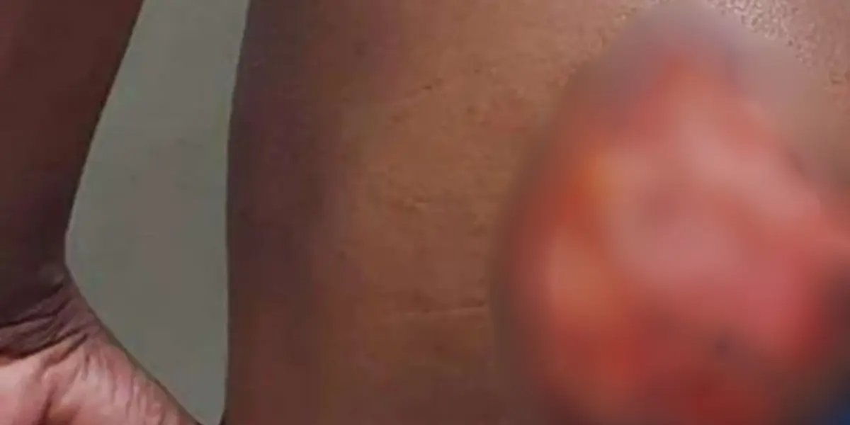 Jovem negro com deficiência auditiva é marcado com ferro no sudoeste da Bahia; irmãos são presos