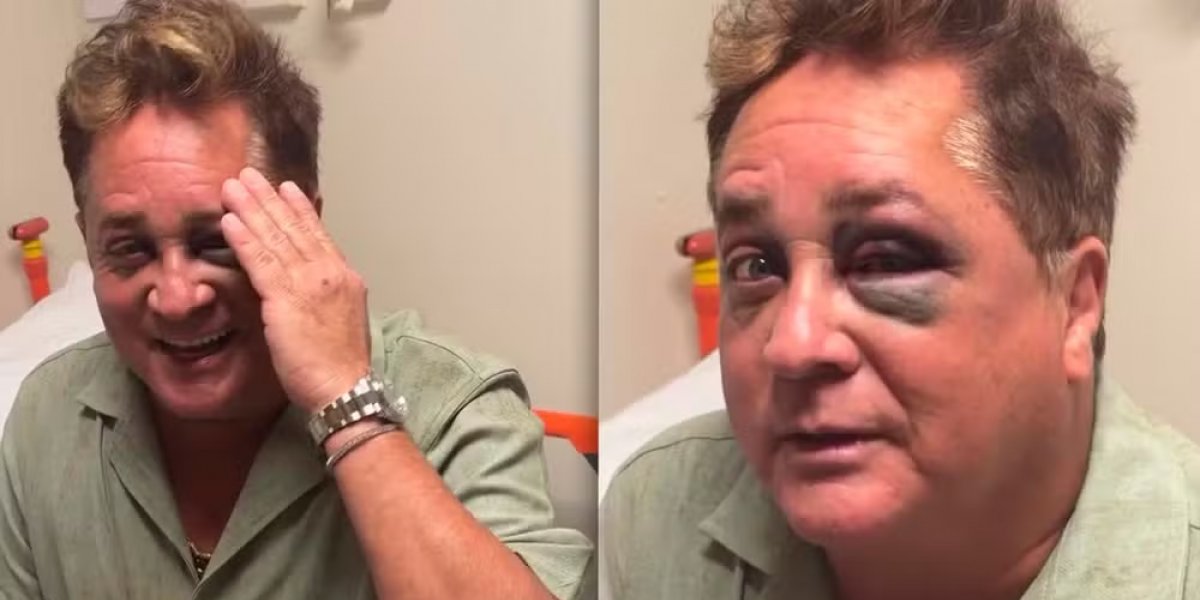 Leonardo com olho roxo