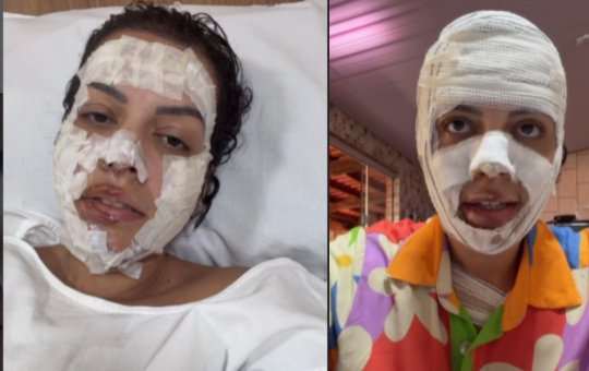 Nutricionista sofre queimaduras após explosão de saco de lixo