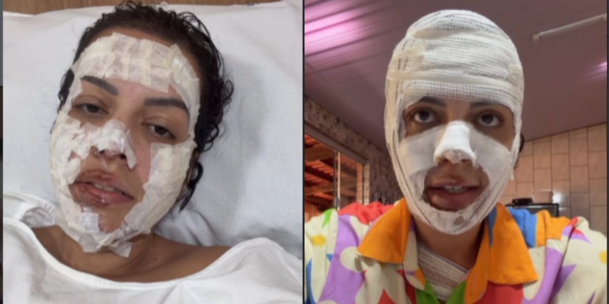 Nutricionista sofre queimaduras após explosão de saco de lixo