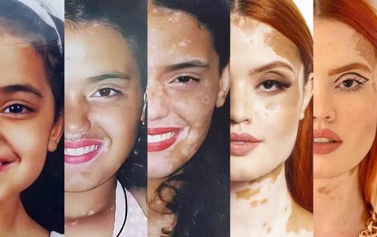 Vitiligo além da pele: estigmas sociais da condição ganham espaço nas redes sociais