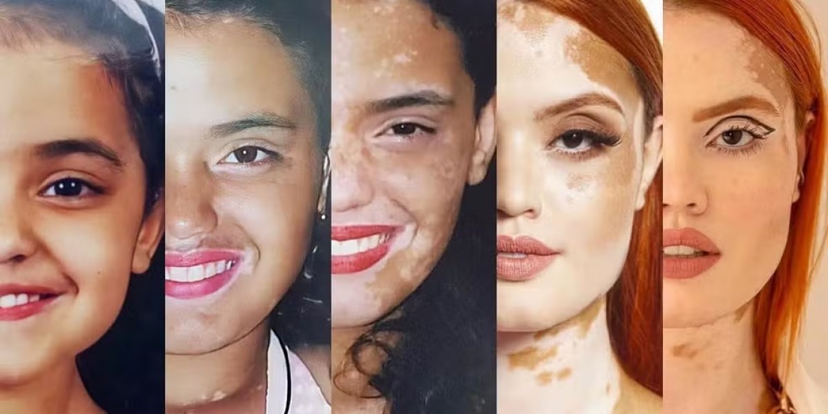 Vitiligo além da pele: estigmas sociais da condição ganham espaço nas redes sociais