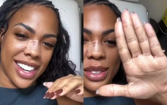 Ex-BBB Marvvila revela cirurgia para retirar sexto dedo: "Sempre tive vergonha"