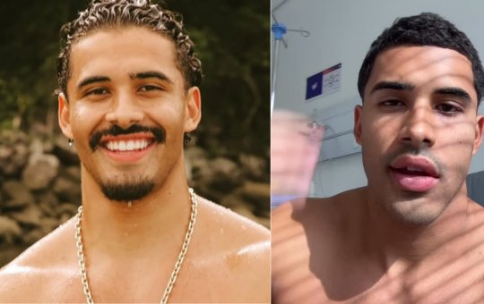 Cantor Nilo Froelich cancela shows após diagnostico de 'paralisia de Bell'